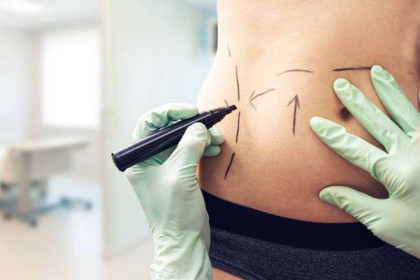 Liposuction in Dynasty Clinic Dubai Jumeirah