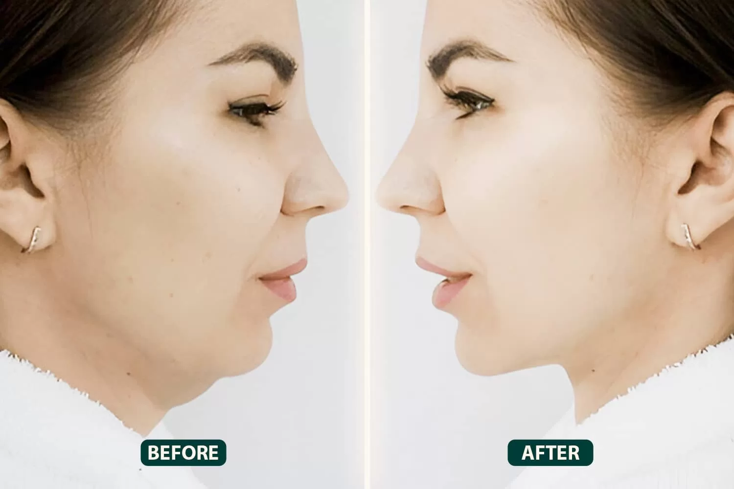 Face Lift Surgery