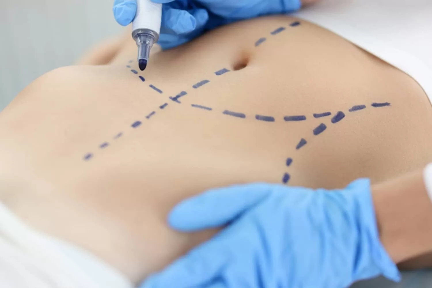 Liposuction in Dubai