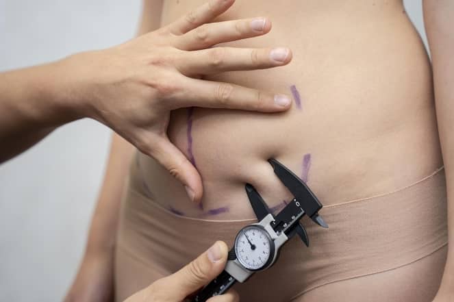 liposuction-in-dubai