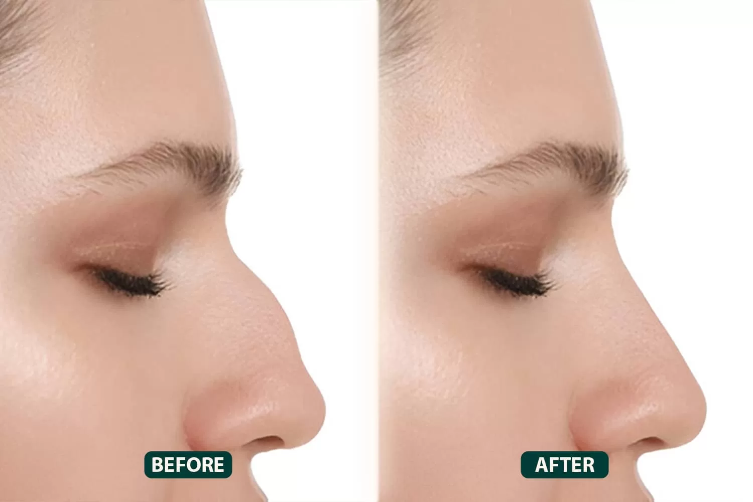 Rhinoplasty In Dubai