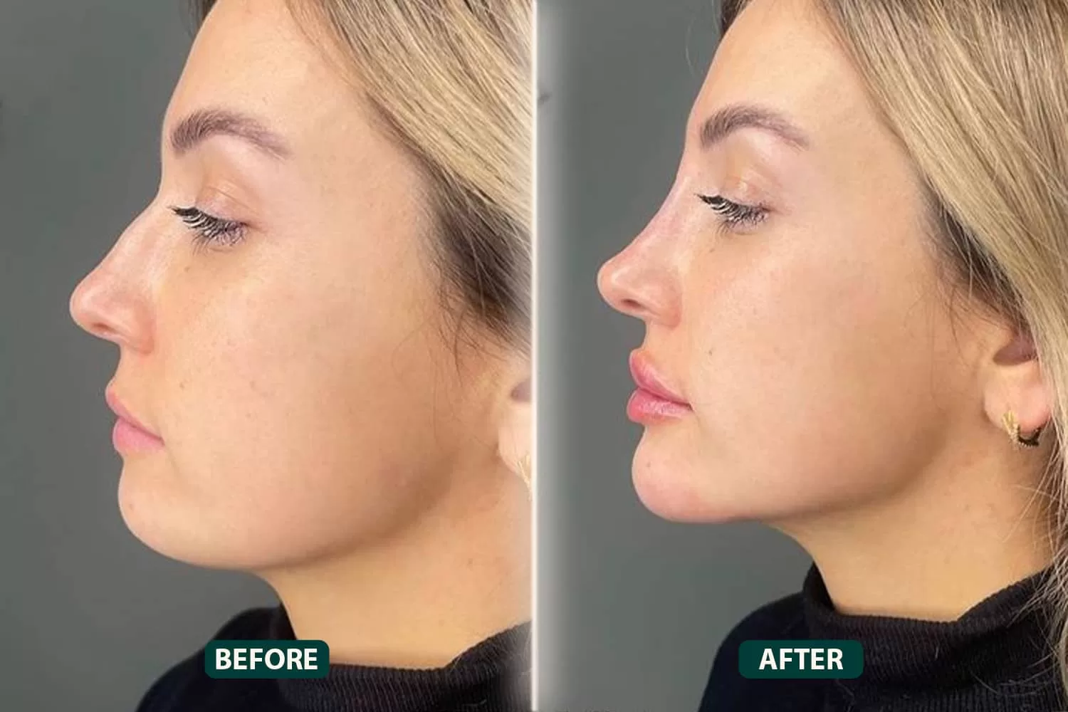 Jawline Correction