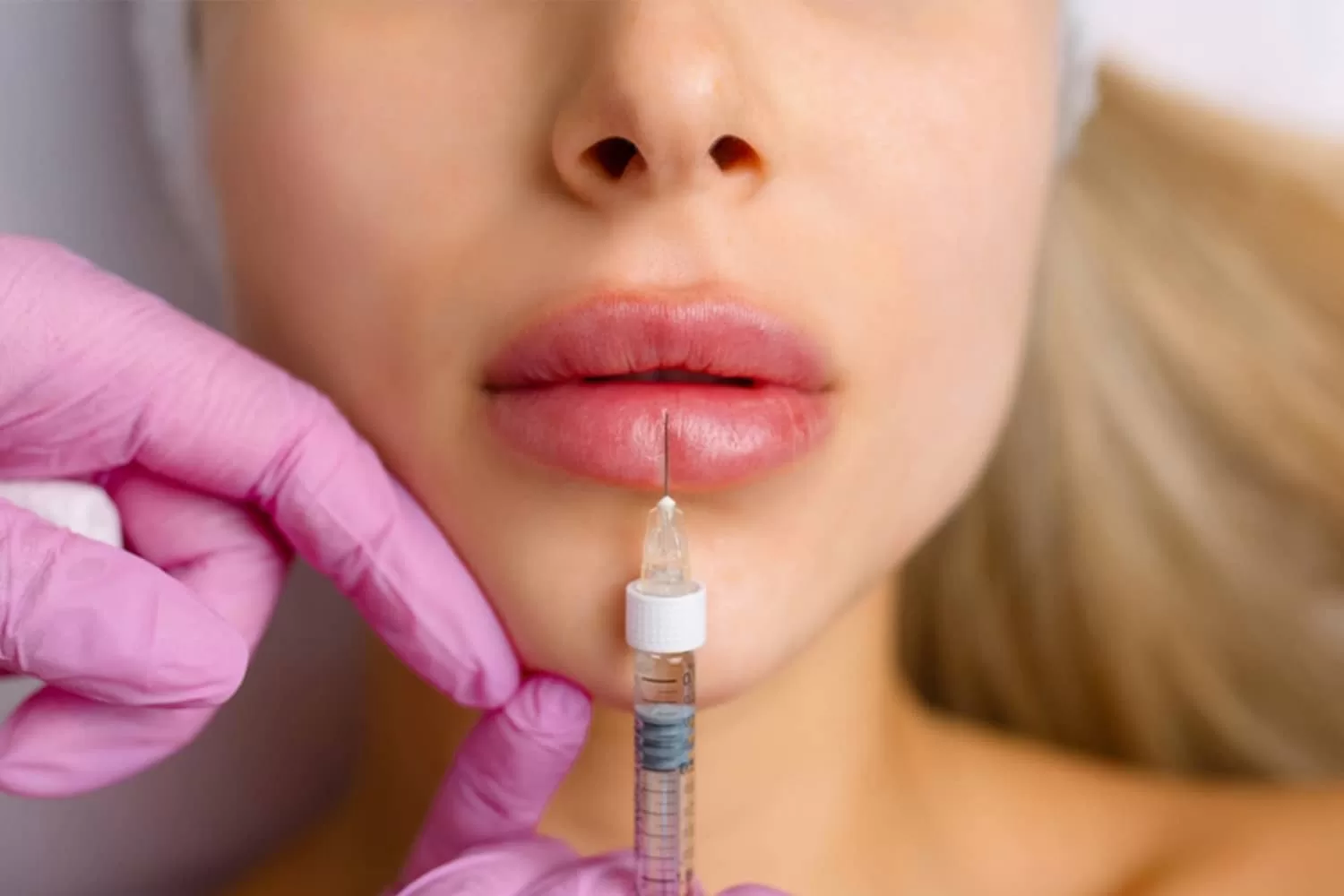 lip filler injection