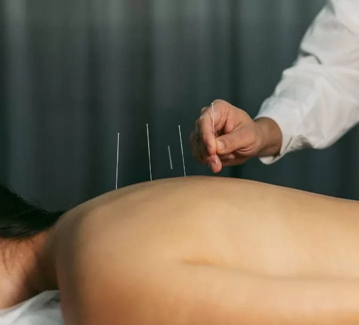 Dry Needling Therapy