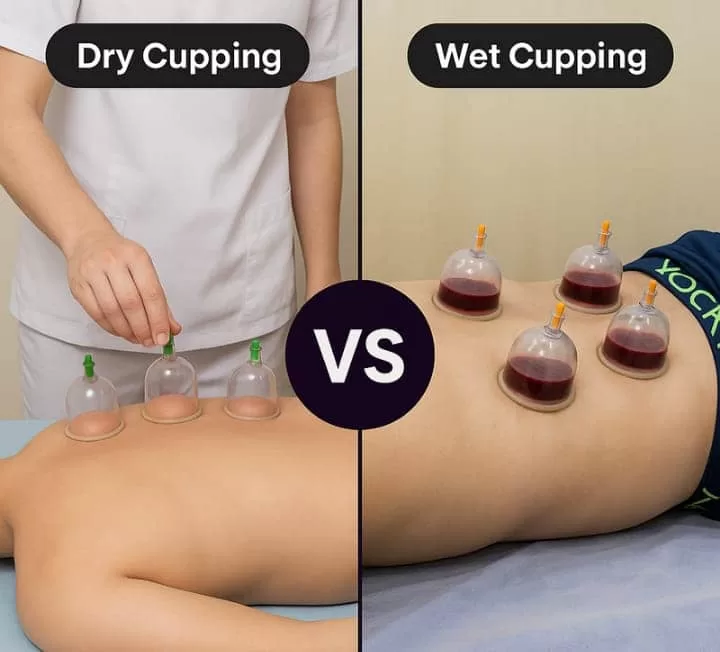 Types of Cupping