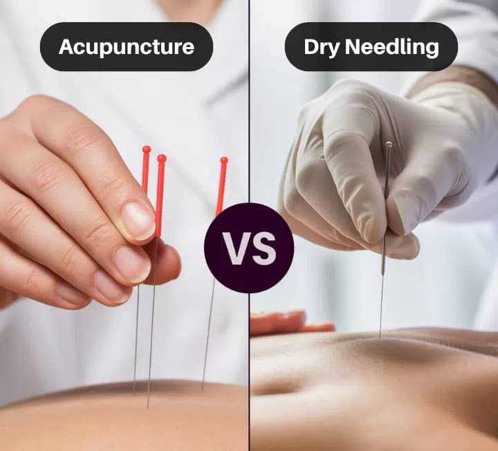 differences between dry needling and acupuncture