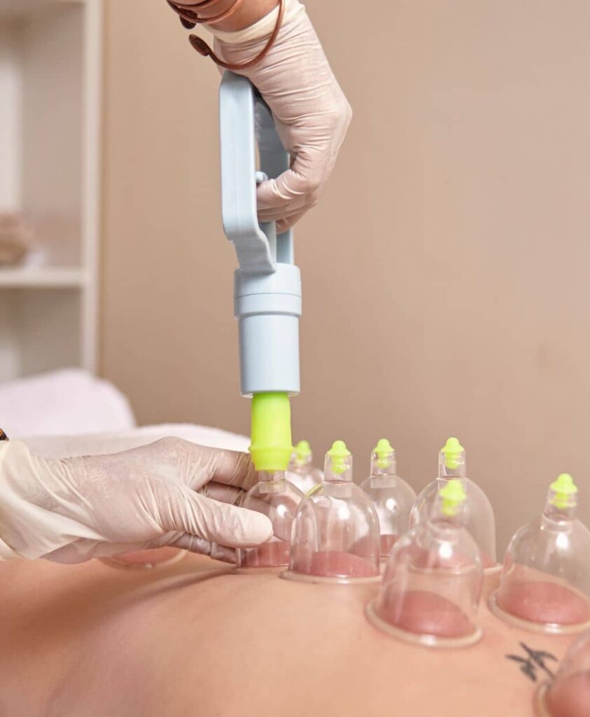 Blood Cupping in Dubai