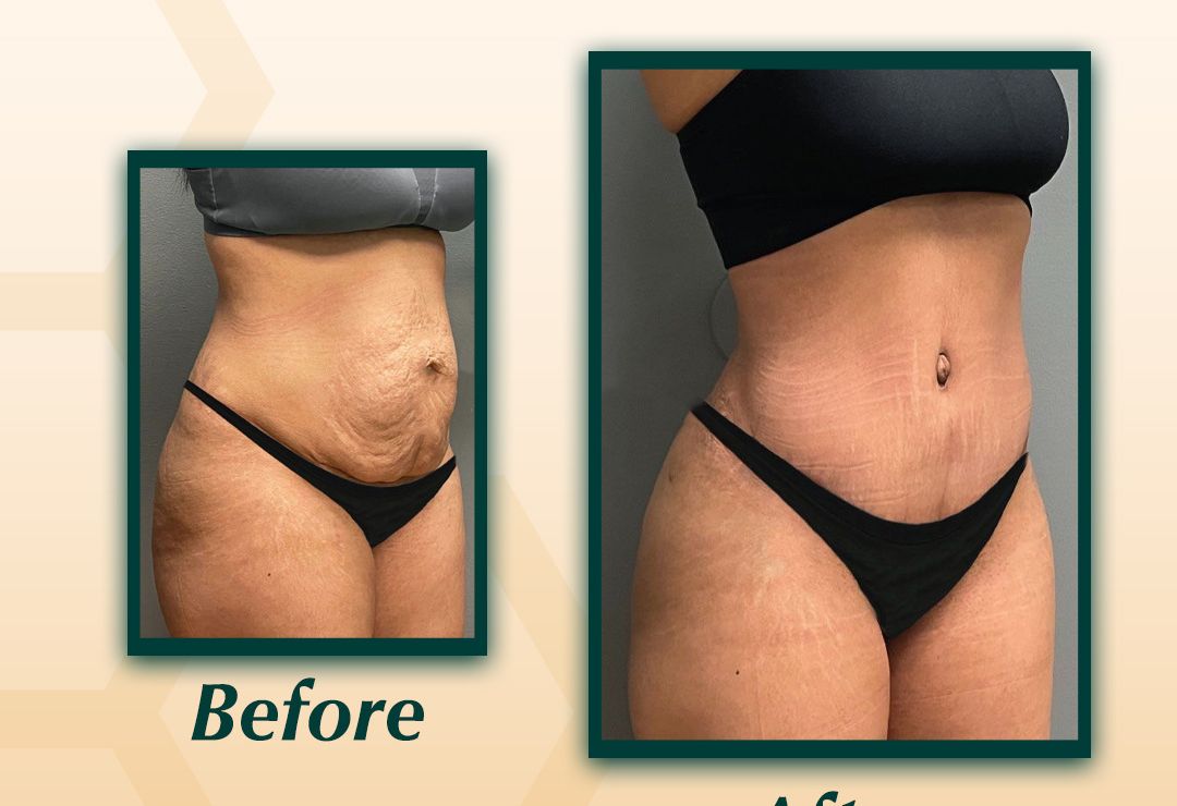 Body Contouring Dubai