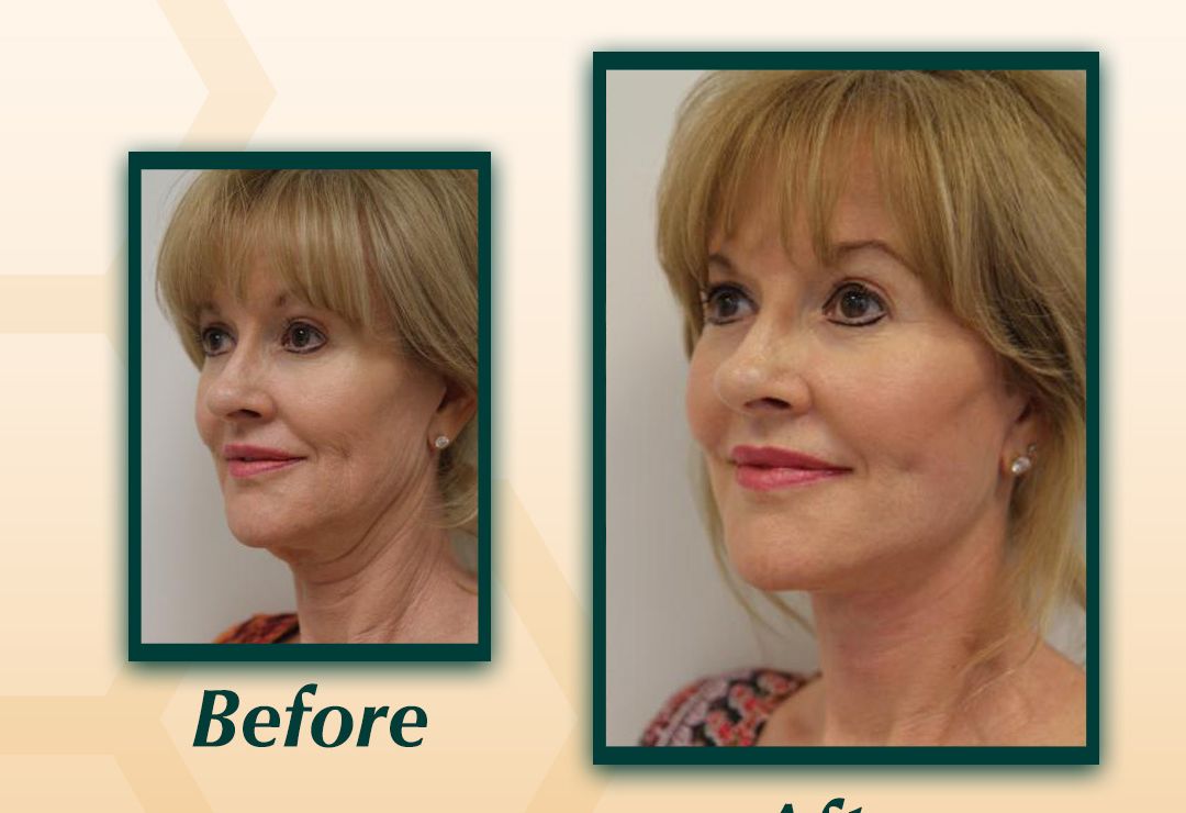 Cheek Lift Surgery in Dubai