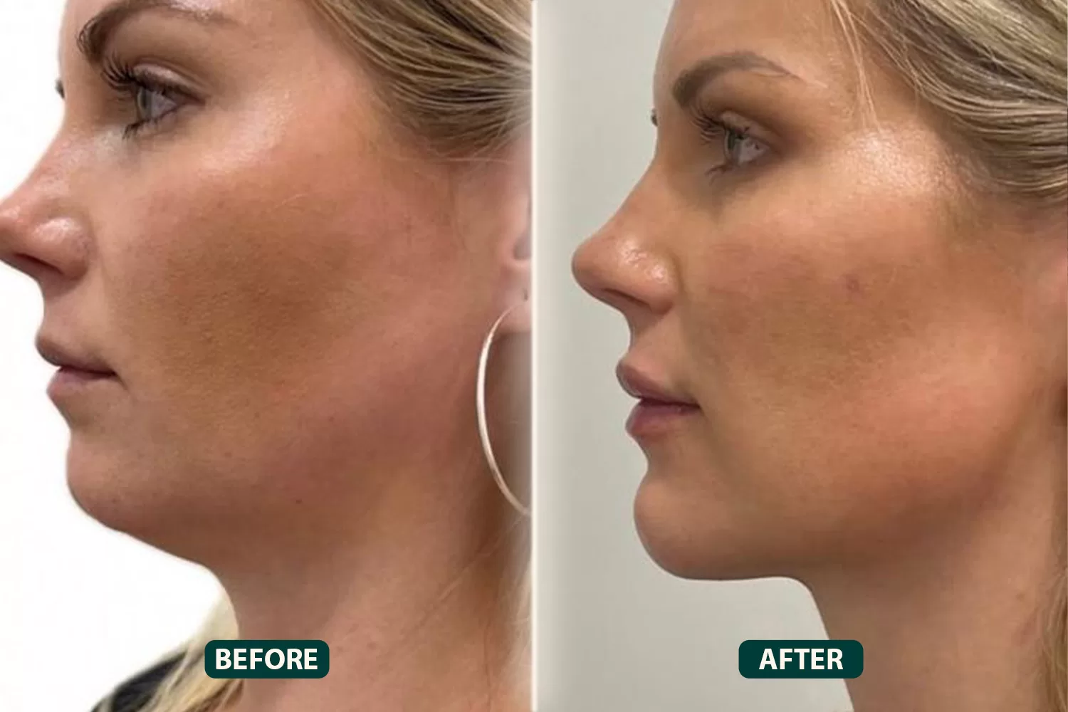 Double Chin Removal