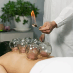 Dry Cupping Therapy in Dubai