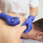 Dry Needling Therapy