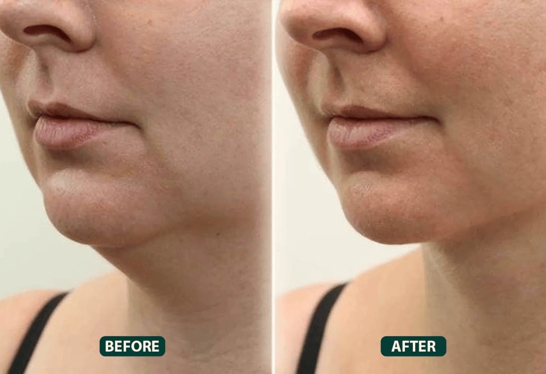 Fat Melting Injections