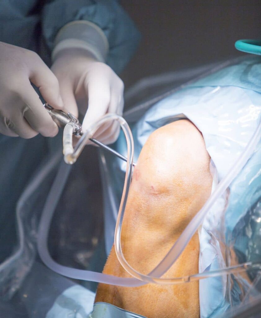 Knee Arthroscopy in Dubai