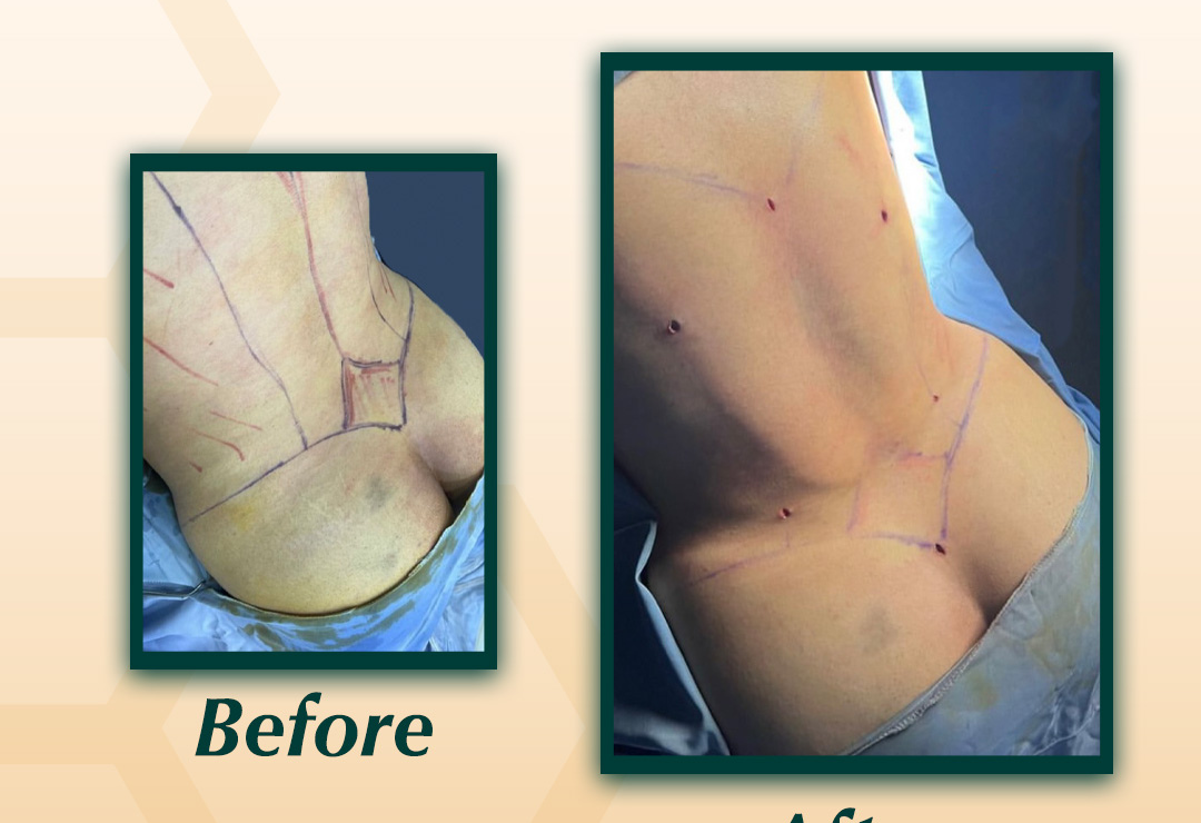 Safe BBL Procedure Dubai