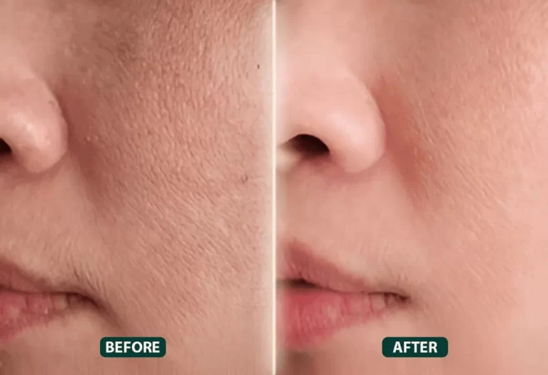 Skin Booster Treatment