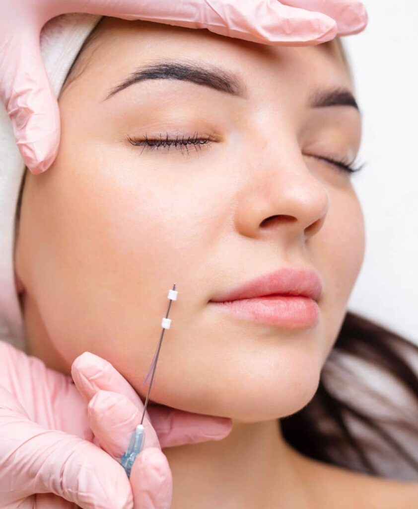 Thread Lift Treatment