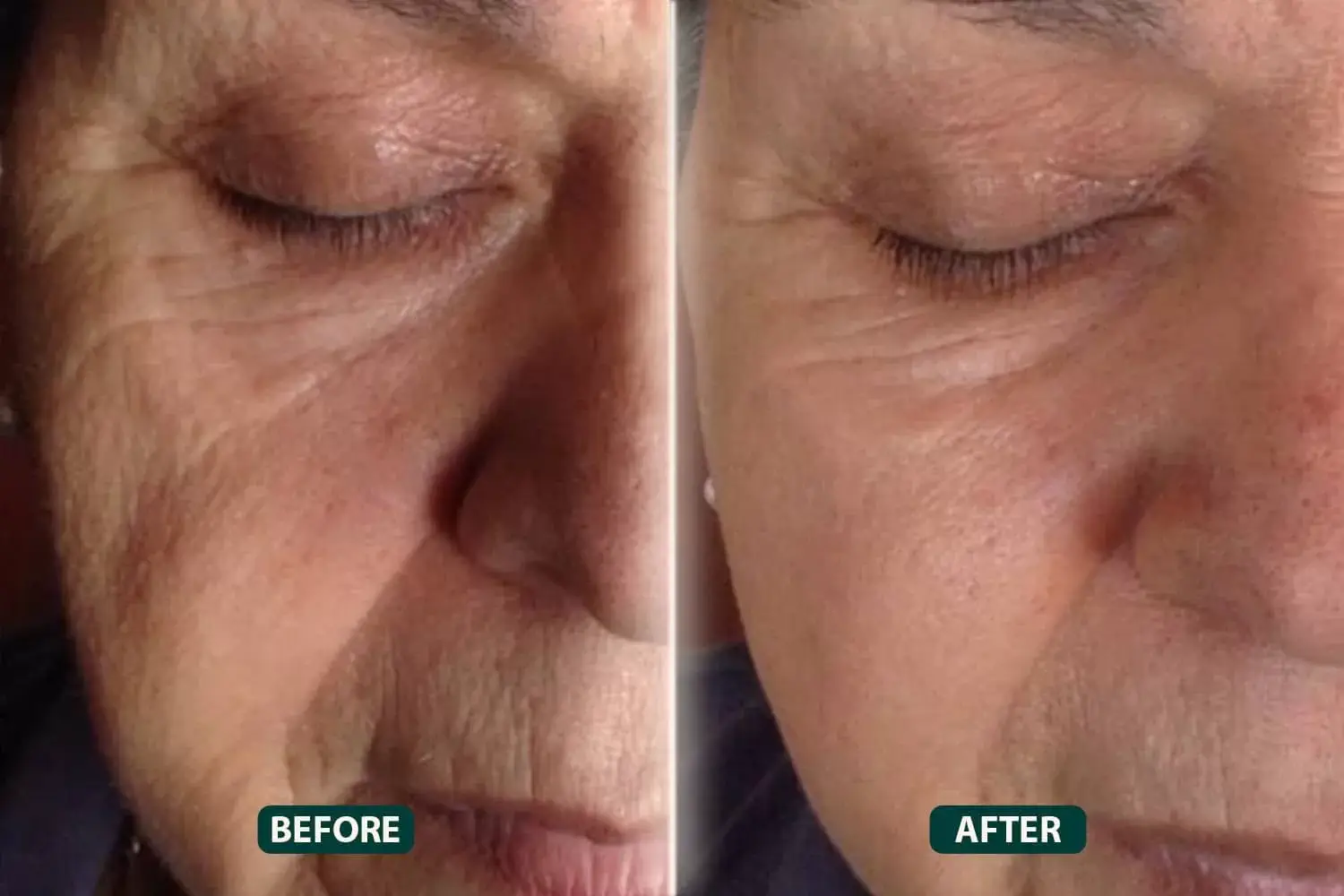 Thread Lift Treatment