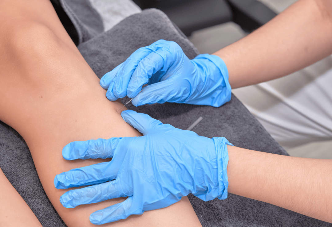 What Is Dry Needling