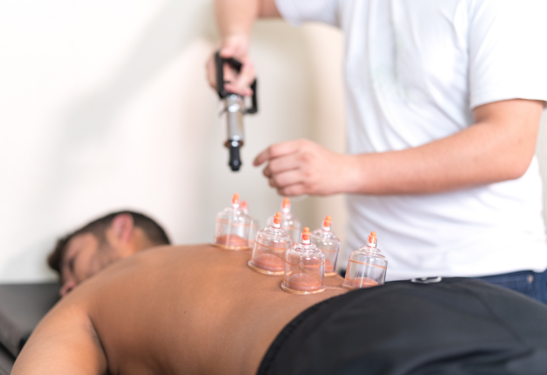cupping therapy