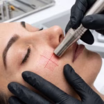 Is Endolift Safe for All Skin Types