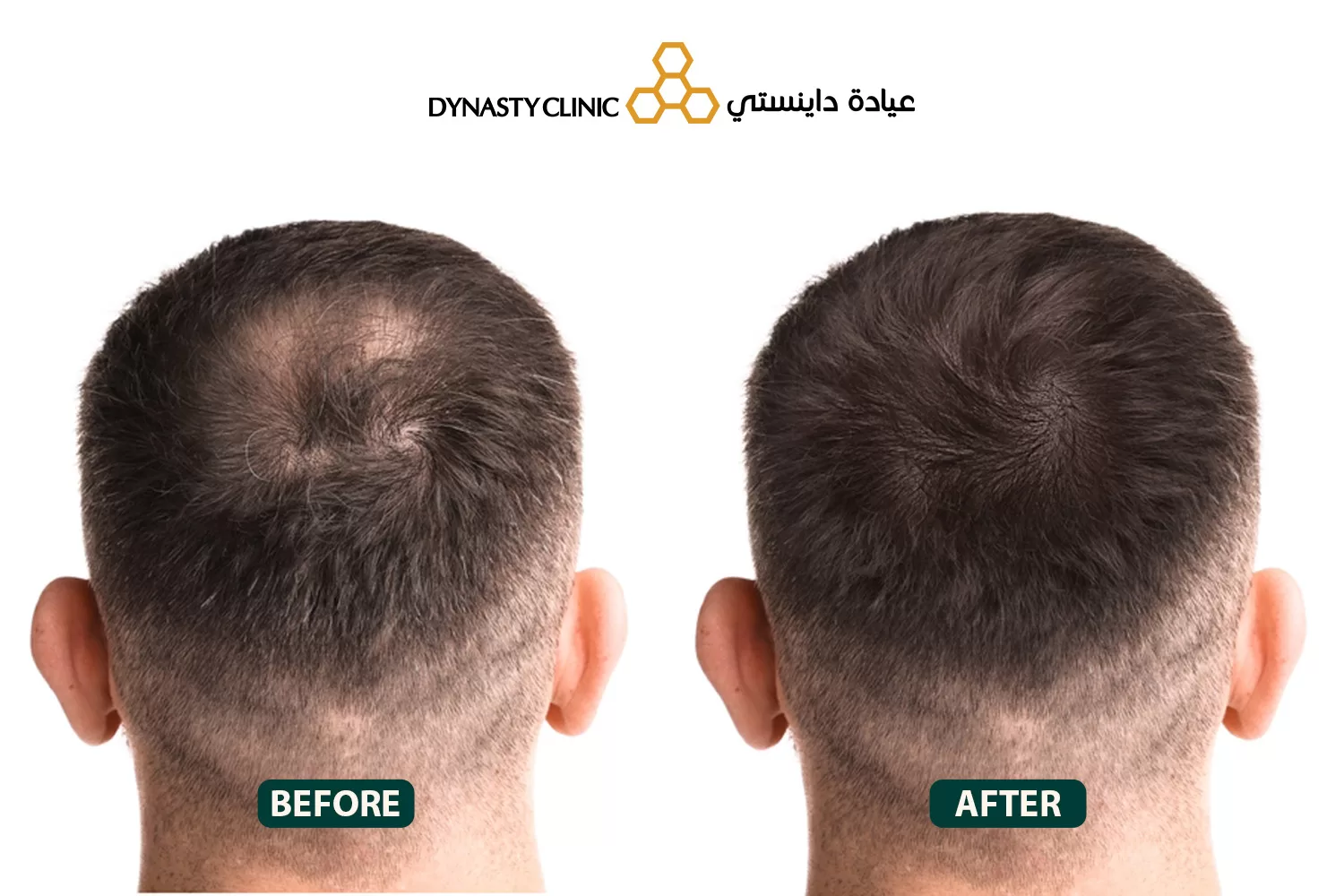 stem cell hair treatment in Dubai