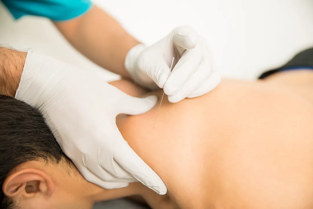 Dry Needling in Dubai