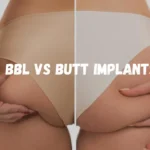 BBL vs butt implants