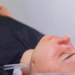 Rosacea Treatment