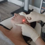 What is Endolift