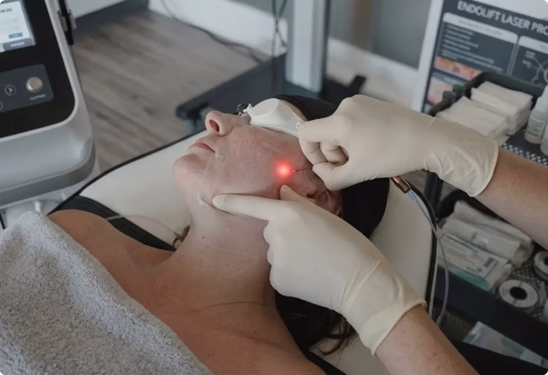What is Endolift
