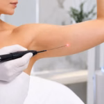 Endolift for Arms