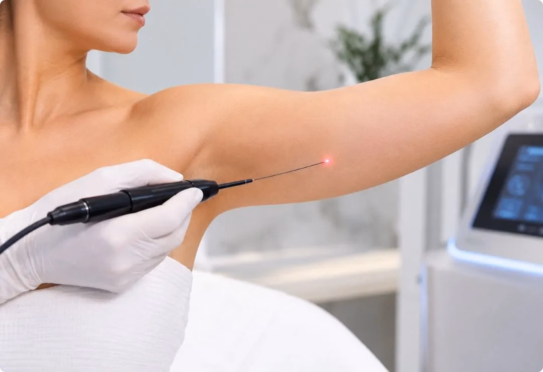 Endolift for Arms