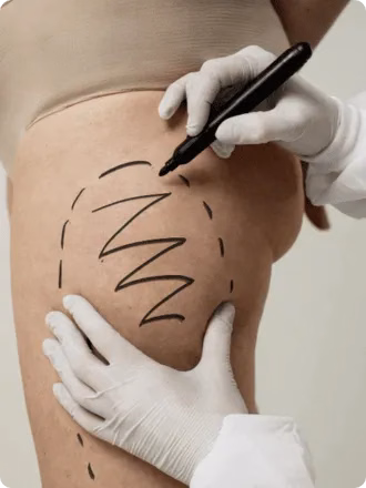 Endolift for Thighs