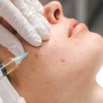 exosome therapy for acne scars