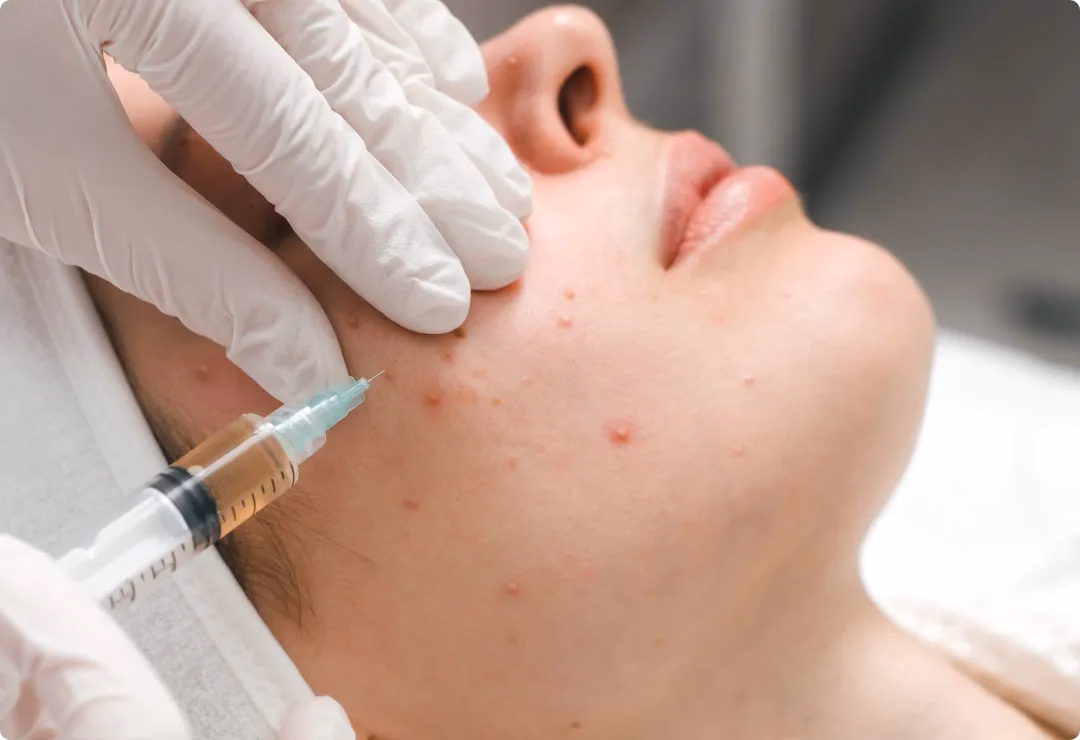 exosome therapy for acne scars