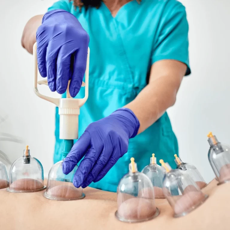 Blood Cupping Therapy