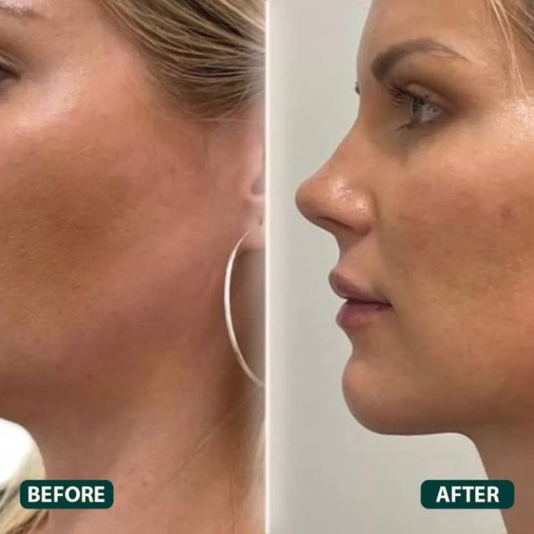 Double Chin Removal
