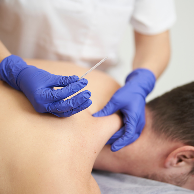 Dry Needling Therapy