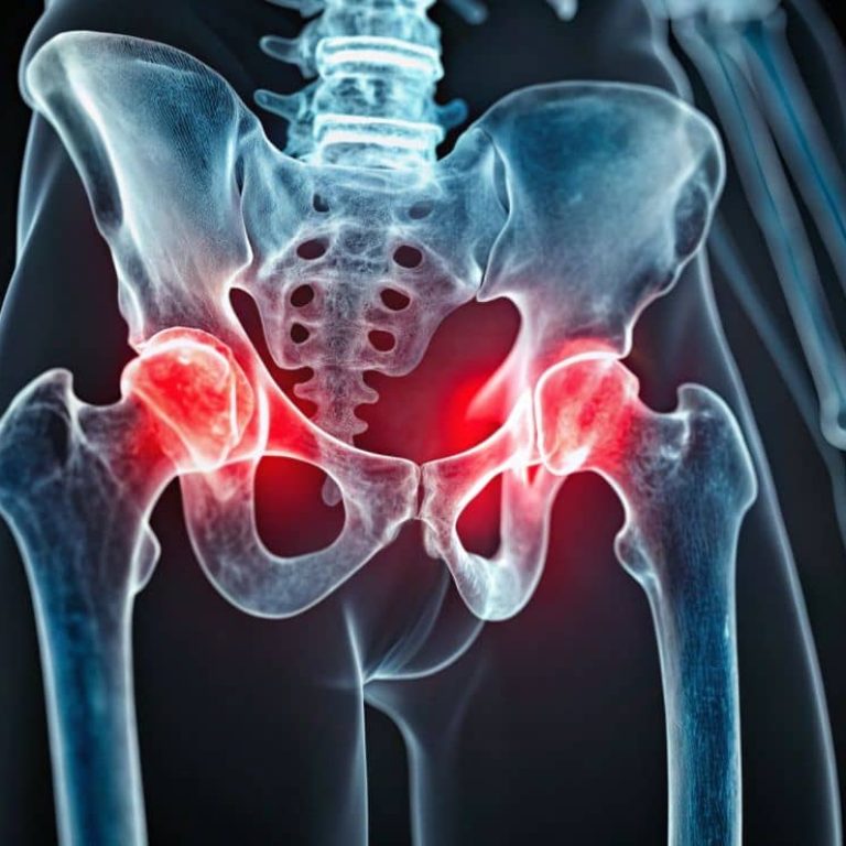 Hip Replacement Surgery