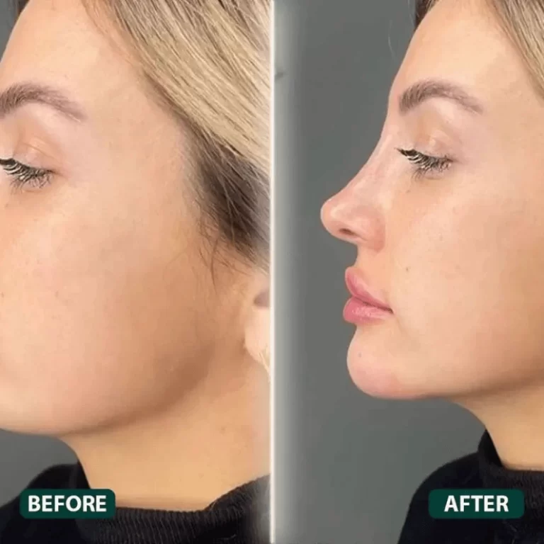 Jawline Correction