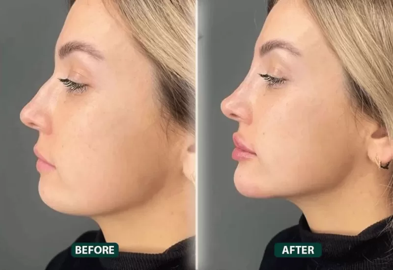 Jawline Correction