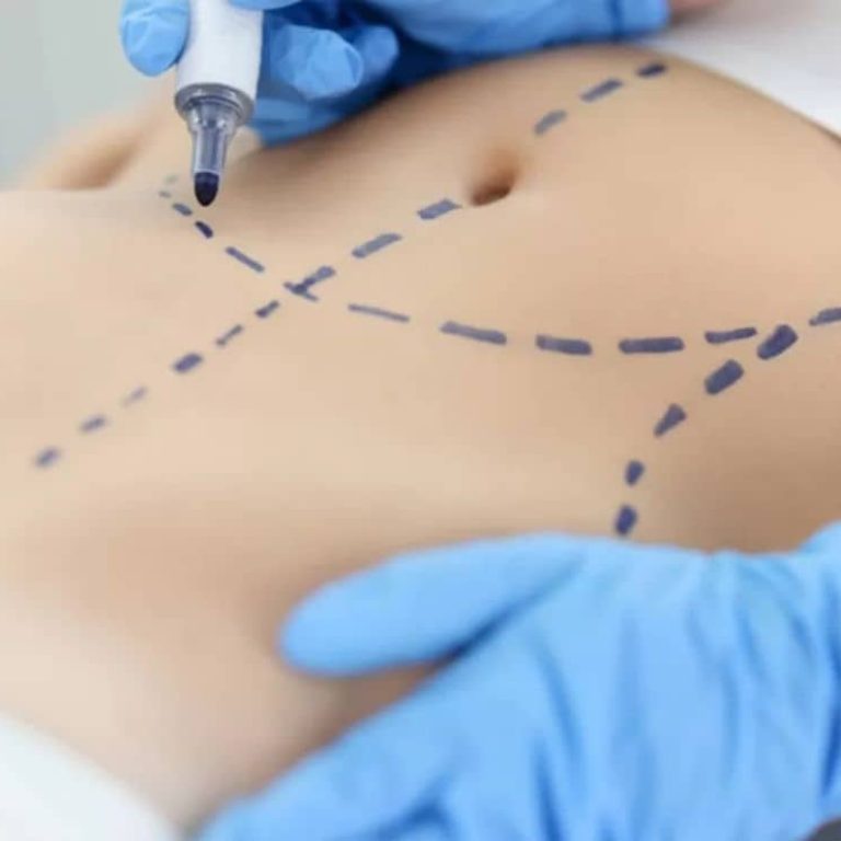 Liposuction in Dubai