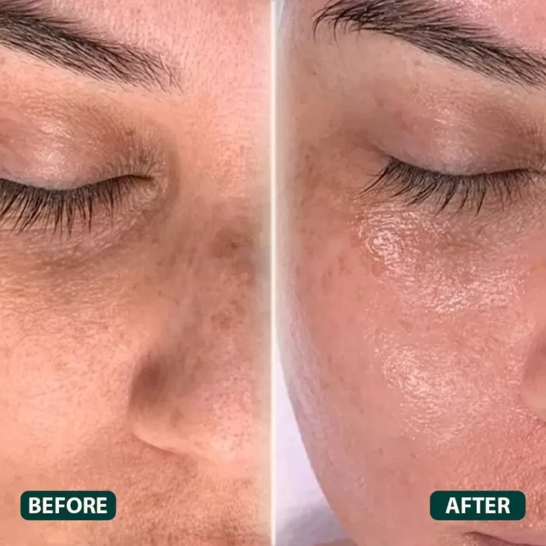 Mesotherapy Injections