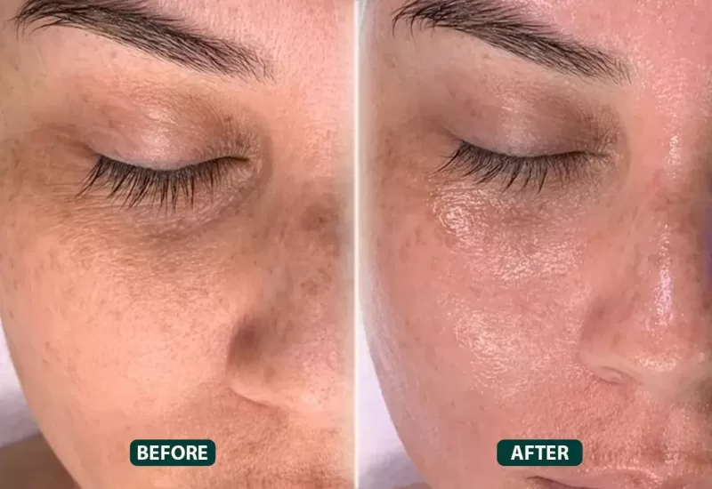 Mesotherapy Injections