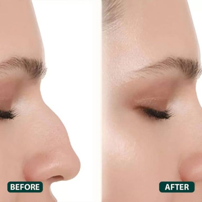 Rhinoplasty In Dubai