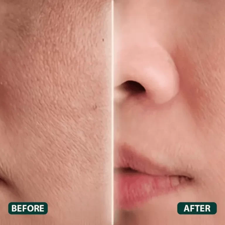 Skin Booster Treatment