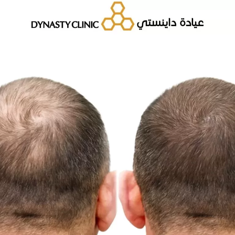 Stem Cell Hair Treatment