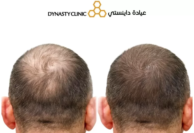 Stem Cell Hair Treatment
