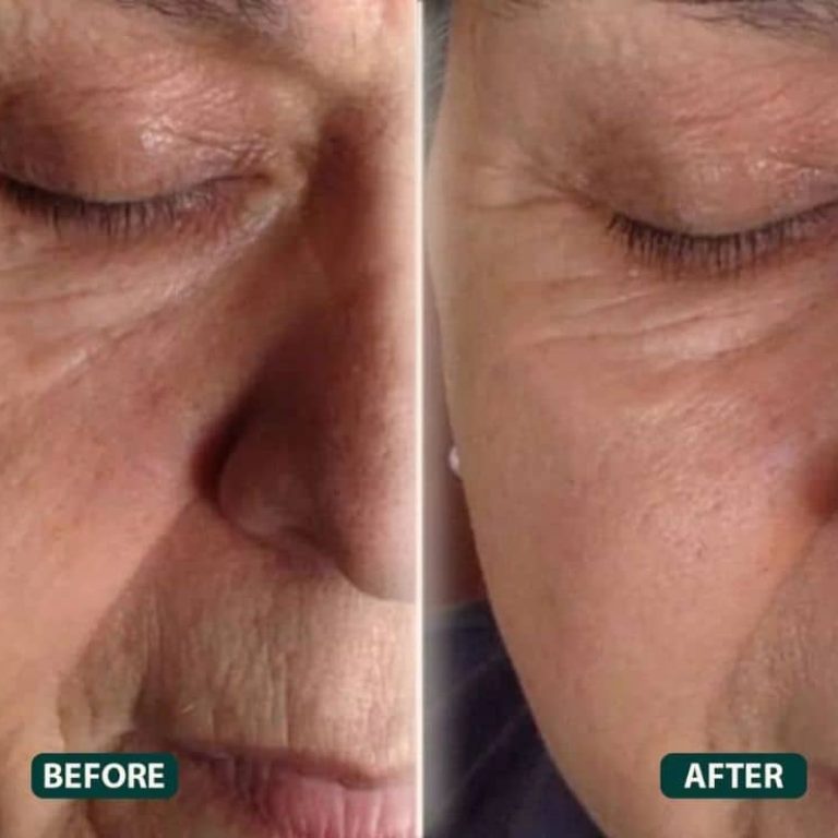 Thread Lift Treatment